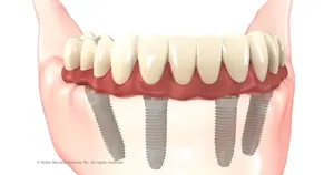The All On 4 Implant Surgery technique.  Is it REALLY possible to get a full set of teeth on only 4 implants?