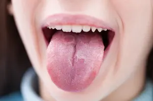 Read about Burning Tongue Syndrome home remedies. Find out what you can do to help, by dentist Dr. Richard Mitchell