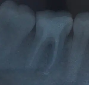 Root canal complications include calcified root canals and bent roots. By dentist Dr. Richard Mitchell.