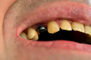 Does a dental implant infection spell the end of your implant? Read about the FOUR possible infections here.