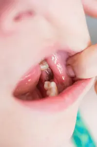 Tooth extraction infection - The difference between an extraction infection and a DRY SOCKET