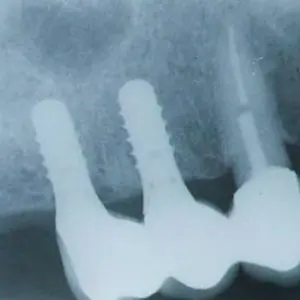 Read about dental implant healing, and what affects the speed of healing. How fast can you get an implant crown put on?