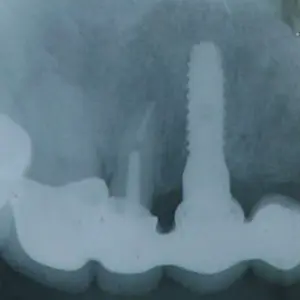 implant Xray