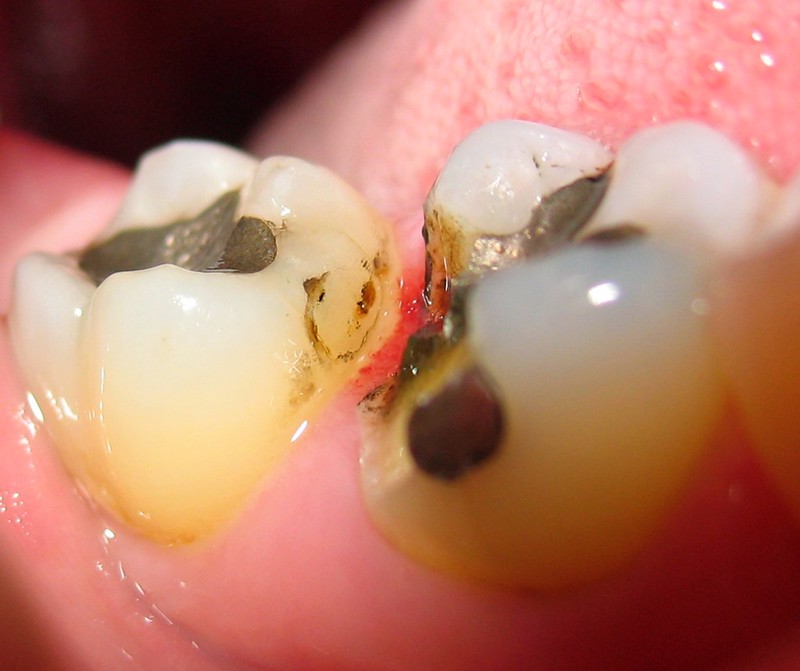 Close-up of two molar teeth and a broken filling Close-up of two molar teeth and a broken filling