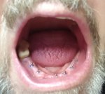 denture implants in mouth
