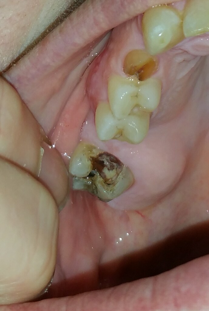A tooth cavity in an upper molar tooth A tooth cavity in an upper molar tooth