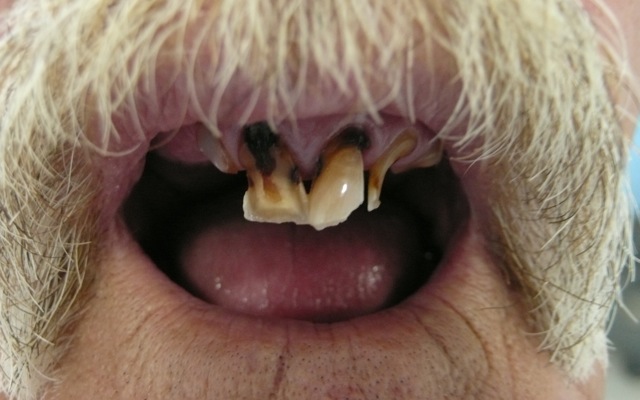 Close up image of a mans 2 remaining front teeth, with a big grey mustache. Close up image of a mans 2 remaining front teeth, with a big grey mustache.