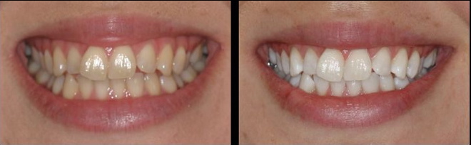 Before and after photos of teeth whitening - KoR whitening