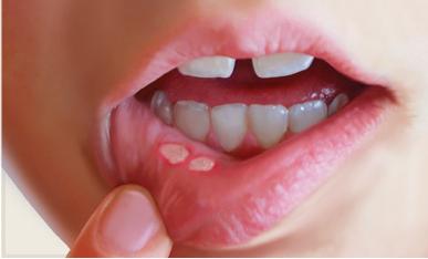 A woman holding her lower lip out with one finger to show 2 aphthous ulcers