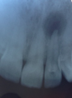 X ray of 3 front teeth, showing a black area around the root tip of the middle tooth. X ray of 3 front teeth, showing a black area around the root tip of the middle tooth.