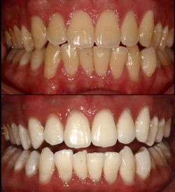 before and after photos of tooth whitening