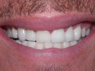 A close-up of the eight upper front teeth after having new dental crowns
