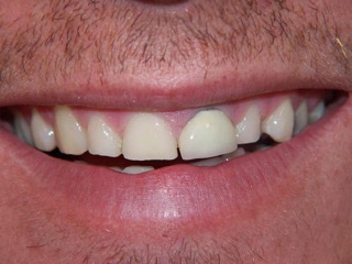 A close-up of the eight upper front teeth showing a grey edge on a crown