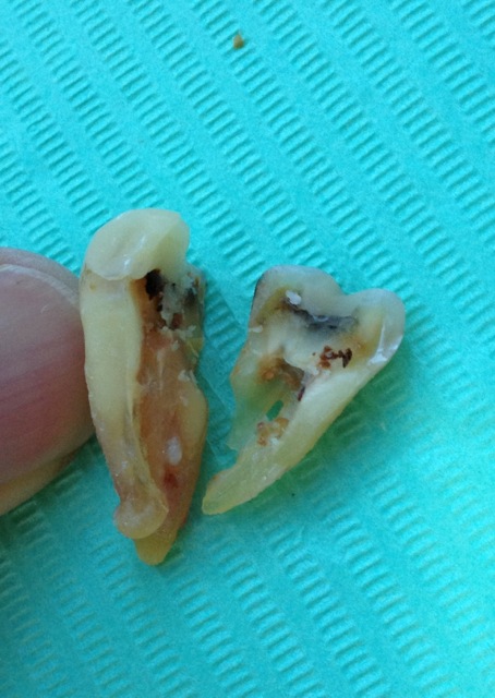 An extracted molar tooth on a green background, with a vertical crack through the root, and the tooth in 2 parts An extracted molar tooth on a green background, with a vertical crack through the root, and the tooth in 2 parts