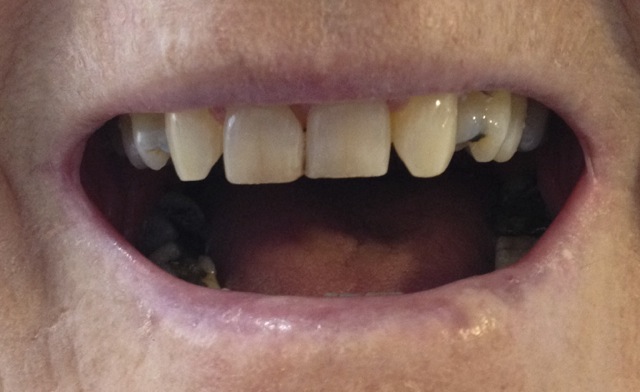 Upper front teeth with some gaps