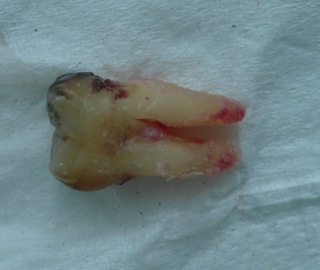 An extracted molar tooth on a white background An extracted molar tooth on a white background