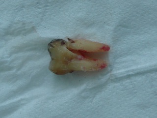 An extracted molar tooth on a white background showing a crack through one of the roots An extracted molar tooth on a white background showing a crack through one of the roots