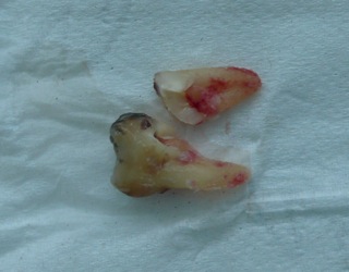 An extracted molar tooth on a white background, with one of the roots separated from the tooth. An extracted molar tooth on a white background, with one of the roots separated from the tooth.