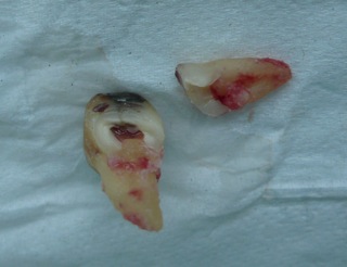 An extracted molar tooth on a white background with a root separated, and the exposed nerve showing. An extracted molar tooth on a white background with a root separated, and the exposed nerve showing.