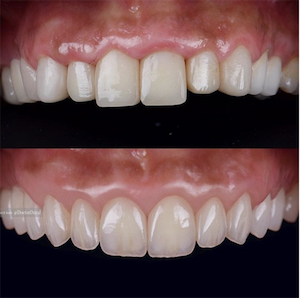 dental veneers before and after