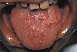 A close-up image of a tongue with features of geographic tongue
