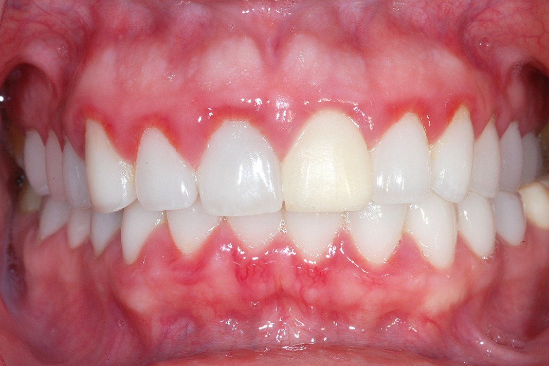 Close-up of teeth showing red gum edges Close-up of teeth showing red gum edges