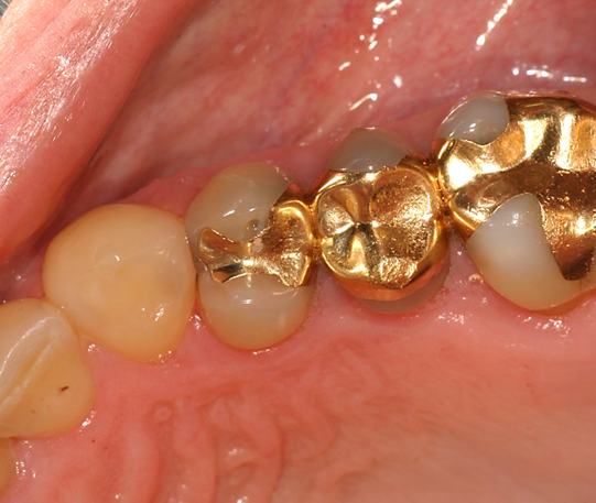 Tooth filling material