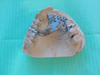 chrome cobalt upper denture chrome cobalt upper denture