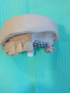 chrome cobalt upper denture chrome cobalt upper denture