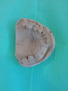 chrome cobalt upper denture chrome cobalt upper denture