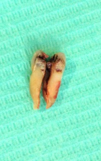 A photo of an extracted premolar tooth on a green background with a fine crack through the root A photo of an extracted premolar tooth on a green background with a fine crack through the root