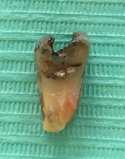 An extracted molar tooth on a green background, with a vertical crack through the root An extracted molar tooth on a green background, with a vertical crack through the root
