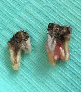 An extracted molar tooth on a green background, with a vertical crack through the root, one side pulled away An extracted molar tooth on a green background, with a vertical crack through the root, one side pulled away