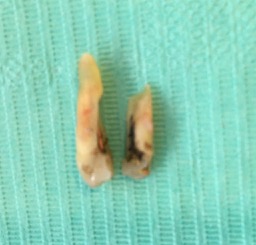 A photo of an extracted premolar tooth on a green background with a fine crack through the root, splitting the tooth into two halves A photo of an extracted premolar tooth on a green background with a fine crack through the root, splitting the tooth into two halves