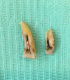 A photo of an extracted premolar tooth on a green background with a crack through the root, and the root in two halves. A photo of an extracted premolar tooth on a green background with a crack through the root, and the root in two halves.