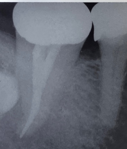 An X-ray of a lower molar tooth with a white line inside the root indicating a root filling