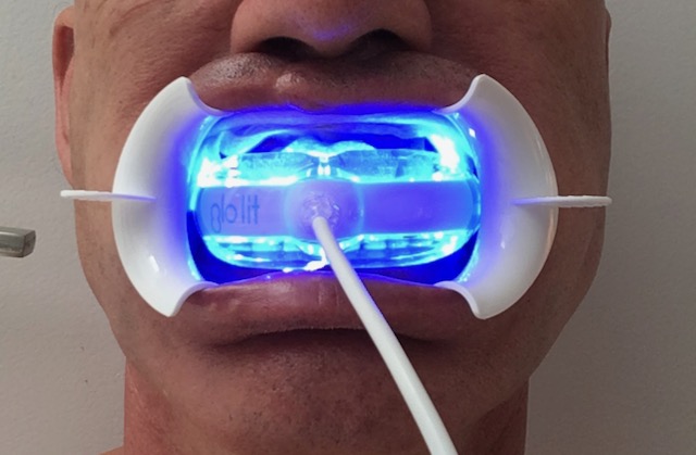A man with a tooth-whitening blue light device in his mouth.