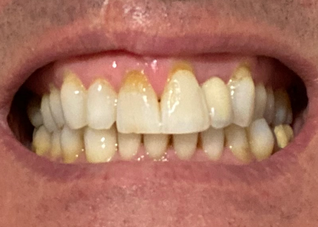 Close-up view of cervical erosion on upper front teeth.