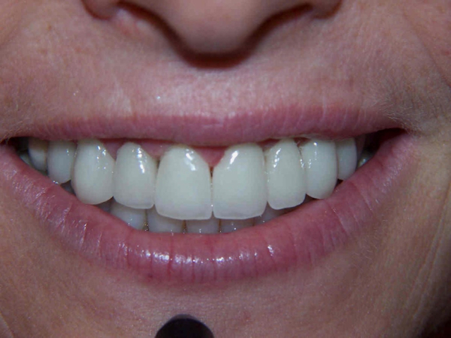 A close-up photo of 8 crowns on upper front teeth