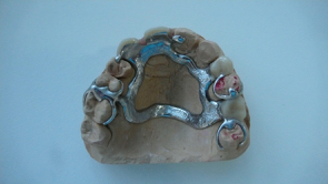 chrome cobalt upper denture chrome cobalt upper denture