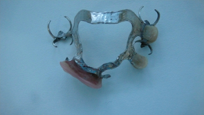 chrome cobalt upper denture chrome cobalt upper denture
