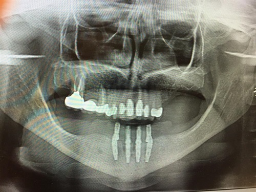 An X-ray of dental implants in the lower jaw after CT scan-based planning