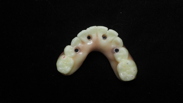 A temporary lower full denture to sit on 4 implants, from above, showing the access holes for the small screws that will hold it in place