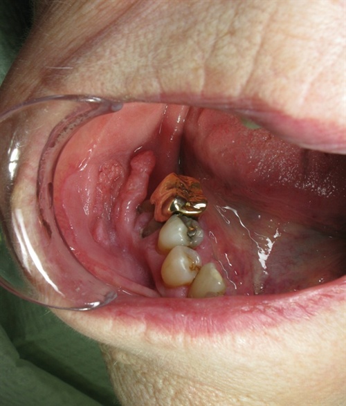 Close up image of a person's lower right teeth and cheek, with a gold crown on the last molar and inflamed cheek tissue. Close up image of a person's lower right teeth and cheek, with a gold crown on the last molar and inflamed cheek tissue.