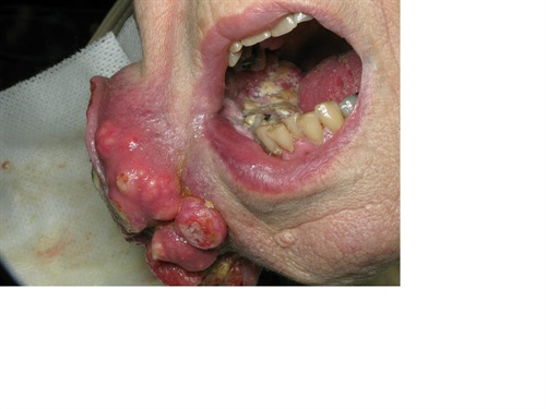 Close-up image of mouth cancer affecting the patient's teeth. Close-up image of mouth cancer affecting the patient's teeth.