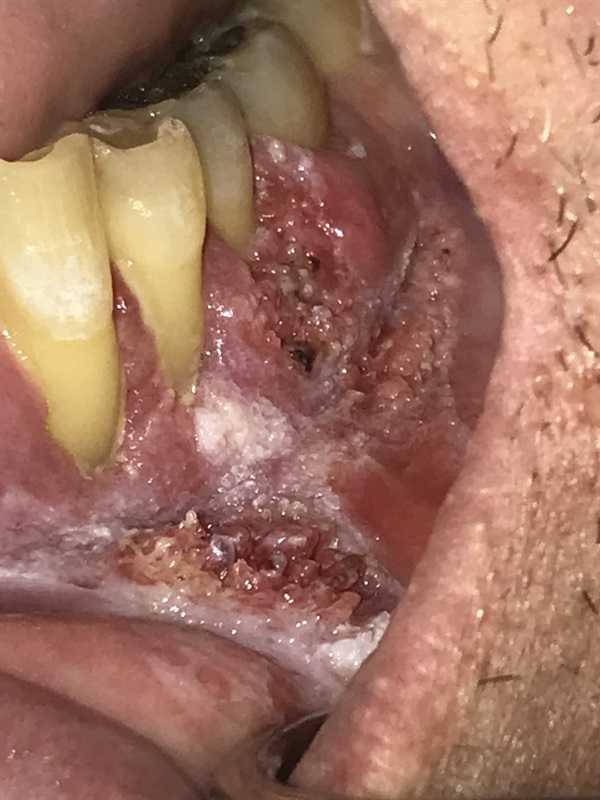 Close-up image of aggressive gum cancer. Close-up image of aggressive gum cancer.