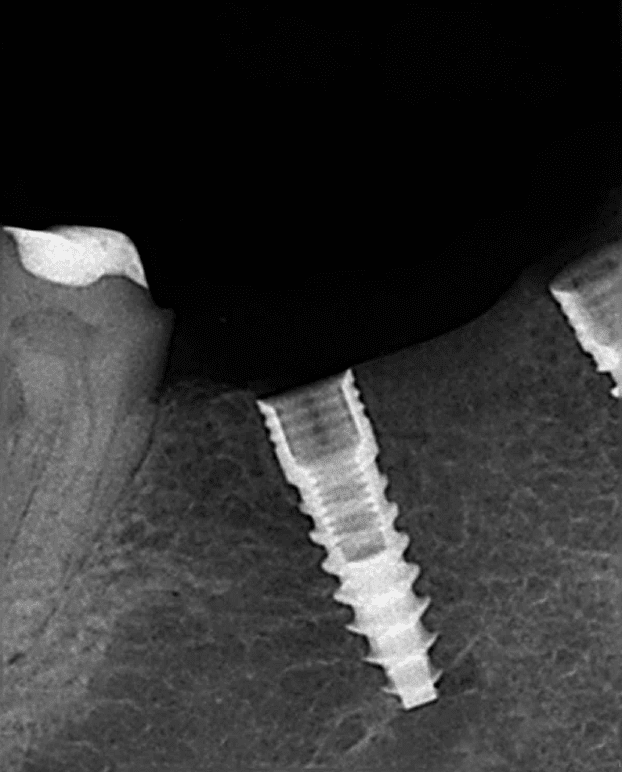 Xray of a dental implant screwed into the jaw bone Xray of a dental implant screwed into the jaw bone
