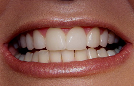 A close-up of a woman's six upper front teeth after having new dental veneers