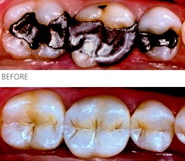 An illustration of old black amalgam fillings in back teeth at the top and how they look with tooth colored composite fillings
