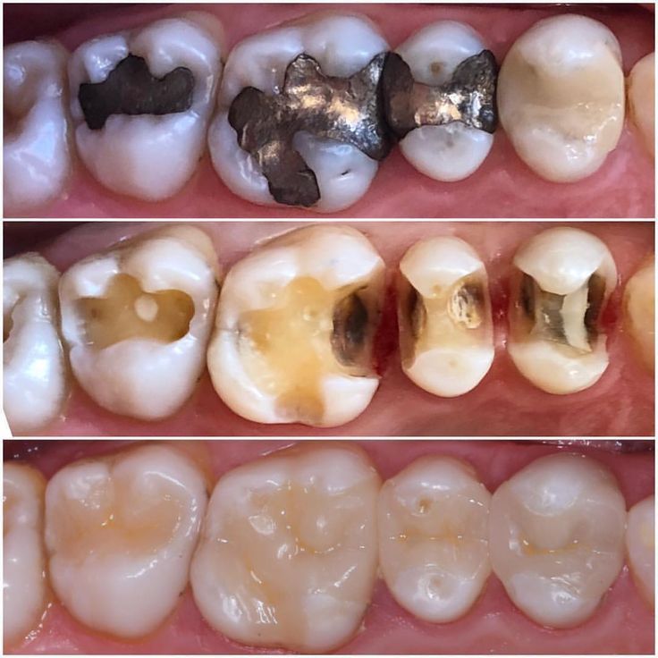 What Are Silver Amalgam Fillings Made Of At Sherry Stamps Blog What Are Silver Amalgam Fillings Made Of At Sherry Stamps Blog